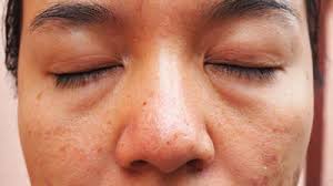 चेहरे पर हल्की सूजन